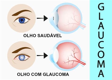 Tratamento De Glaucoma Rj Causas Preven O E Tratamento Dr