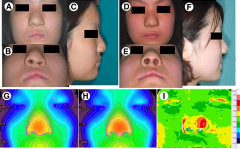 Surgical Technique For Secondary Correction Of Unilateral Cleft Lip