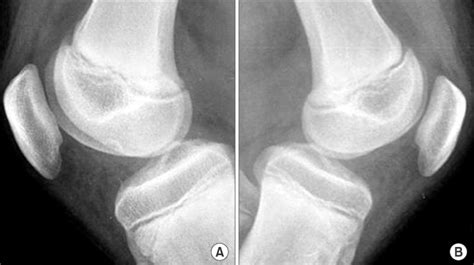 Patella Hairline Fracture