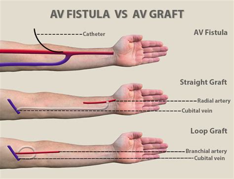 Difference Between Fistula And Graft Differences Finder