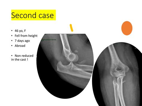 Coronoid Fracture Fix Or Not Pptx