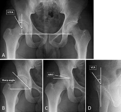 Measurement Of Each Parameter In The Anteroposterior Pelvic View A C