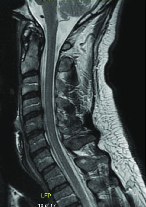 Cervical spine MRI on initial presentation. On T2 weighted image, a... | Download Scientific Diagram