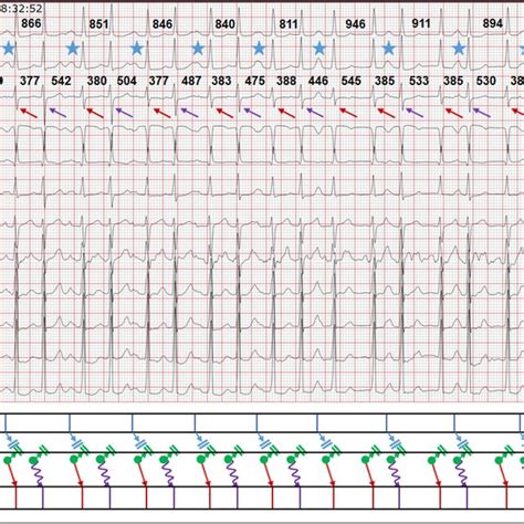 Surface 12 Leads Ecg And Intracardiac Electrograms With Annotations