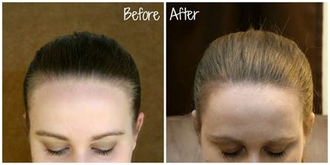 Does Nioxin Work for Hair Loss, Growth & Thinning? | Hair Mag