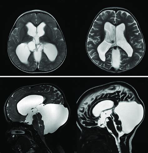 The Magnetic Resonance Imaging T2 Weighted Images Axial Above And