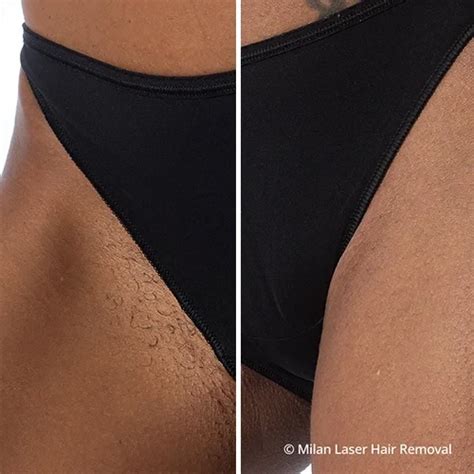 Before After Photos Of Laser Hair Removal Milan Laser In Chicago IL