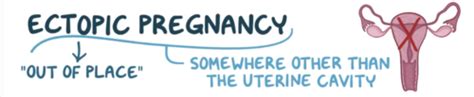 Ectopic Pregnancy Flashcards Quizlet