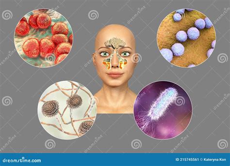 Anatomy Of Rhinosinusitis And Microorganisms That Cause Sinusitis Stock