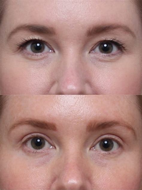 Eyelid Surgery Nashville Before And After Images