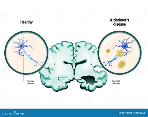 Enfermedad Del ` S De Alzheimer Neuronas Y Cerebro Ilustración Del Vector Ilustración De