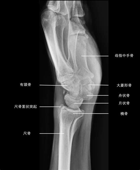 手関節レントゲン写真のみかた−各部位の名前と救急でよくみる骨折について− Daily Orthopedics ~整形外科チャンネル~