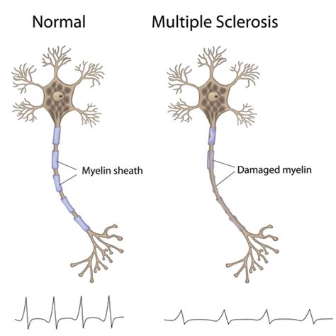 Multiple Sclerosis Overview Etiology Of Ms Ms News Today