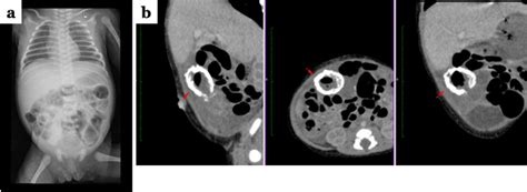 The Importance Of Prenatal Diagnosis For The Surgical Strategy Of Giant