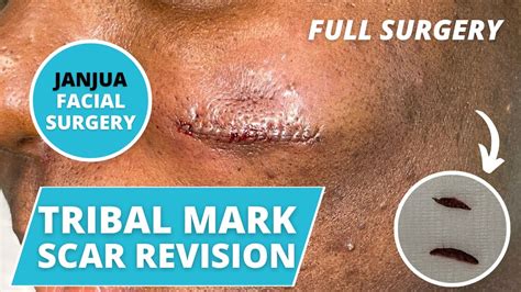 Tribal Mark Scar Revision Live Surgery Dr Tanveer Janjua New