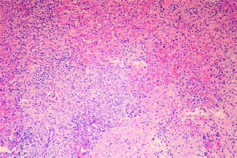 Histological Exam Of The Specimen Hematoxylin And Eosin Stain