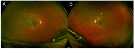 Figure From Bilateral Giant Retinal Pigment Epithelial Tears In