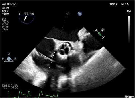 Mid Esophageal Aortic Valve Short Axis View Showing Final Placement Of