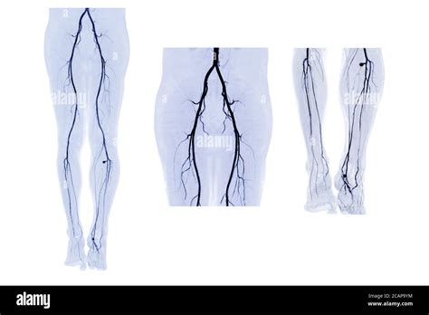 Collection Of Cta Femoral Artery Run Off 3d Mip Image Of Femoral Artery