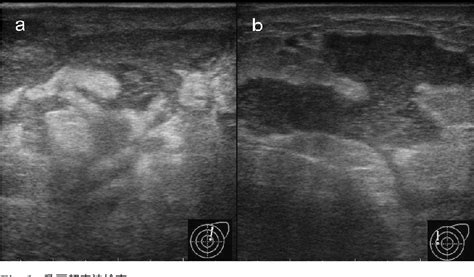 Figure From Granulomatous Mastitis With Erythema Nodosum In A Patient