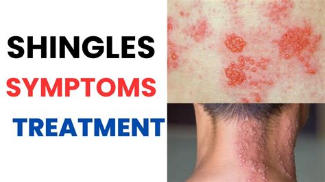 Herpes Zoster Shingles Symptoms Treatment Vaccine Contagious Rash