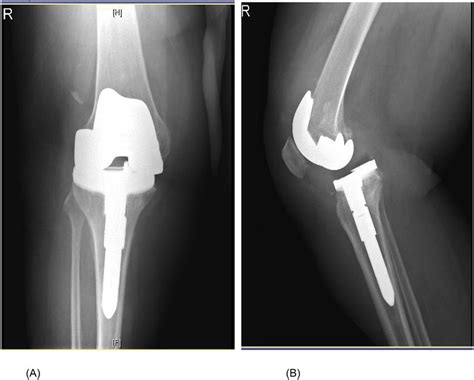 Anteroposterior A And Lateral B Radiographs Showing Dislocation And