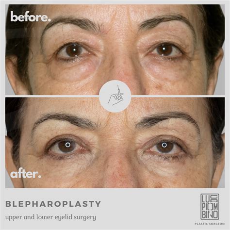 Blepharoplasty Rome All The Info On The Operation Dr Luca Piombino