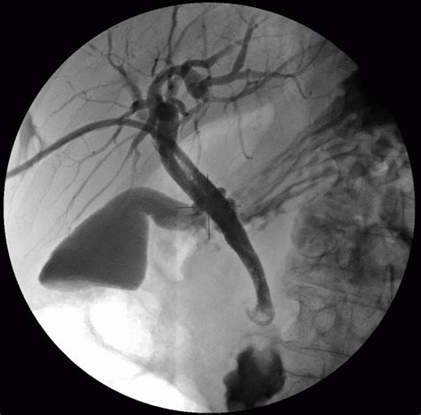 Percutaneous Transhepatic Cholangiography Wikipedia