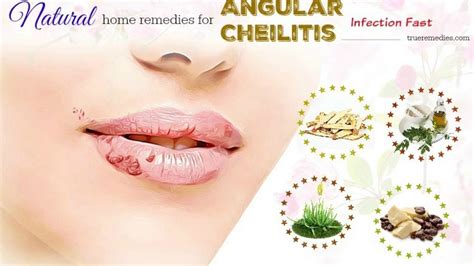 How Do You Treat Angular Cheilitis At Home Property99