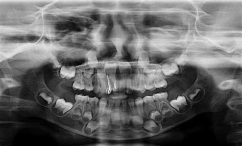 Bilateral Supernumerary Primary Teeth In The Maxillary Anterior Region Bargale Et Al 2015