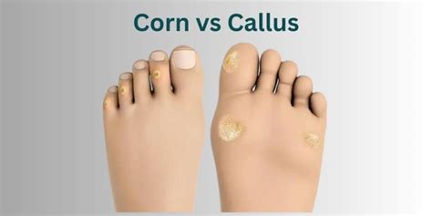 Corn vs Callus: What's the Difference?