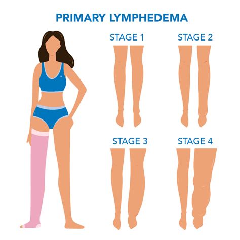 Lymphedema