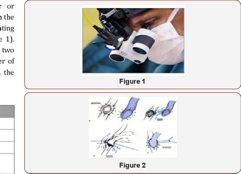 Figure From Long Term Patency Rates Of Saphenous Vein Grafts A