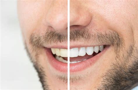 Lo que debes saber sobre el blanqueamiento dental Clínica Dental