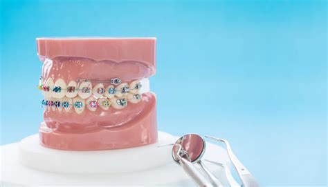 Behel Konvensional Ceramic Usa Oleh Drg Umum Di Neo Art Dental Center