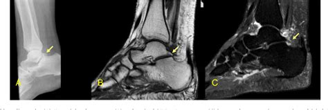 Figure 1 From Posterior Ankle Impingement Syndrome Semantic Scholar