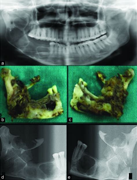 Recurrent Aggressive Multicystic Ameloblastoma With Hemangiomatous