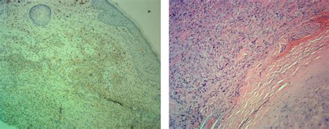 Dermatofibroma To Dermal Sarcoma The Spectrum Of Dermal Spindle Cell