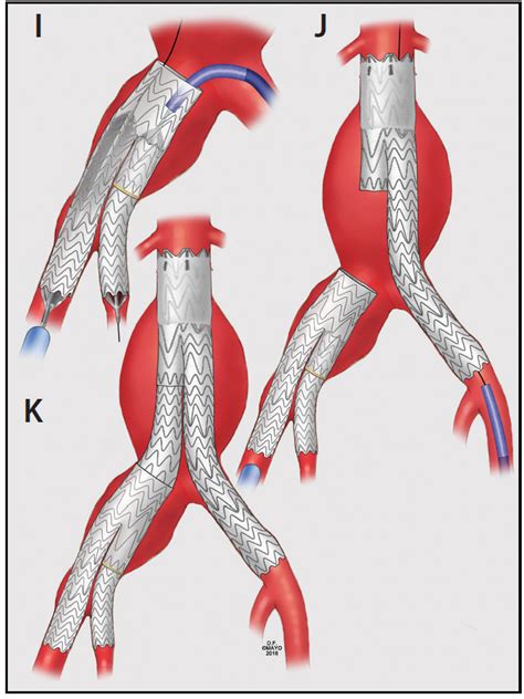 Endovascular Today Techniques Of Endovascular Aortoiliac Repair Using