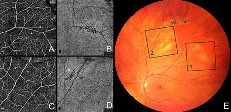 Full Article Spotlight On Lattice Degeneration Imaging Techniques