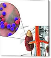 Acute Pyelonephritis Caused By Enterococcus Photograph By Kateryna Kon