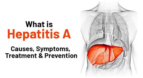 Hepatitis A Its Causes Symptoms Treatment And Prevention