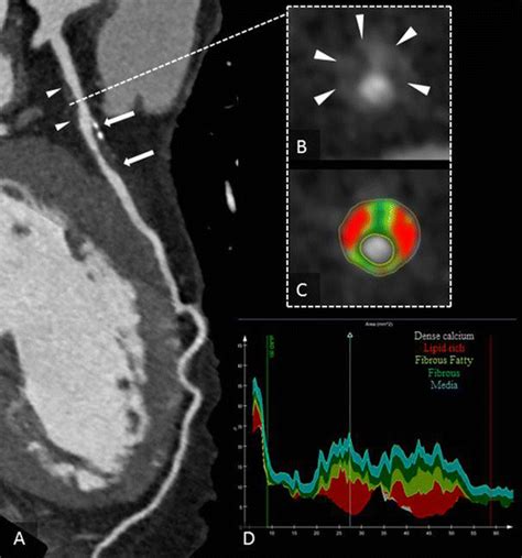 High Risk Plaque Features On Coronary Ct Angiography Springerlink