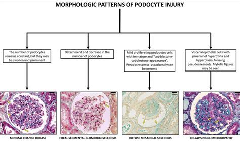 Glomerular Disease Causes Symptoms Diagnosis Treatment And Prognosis