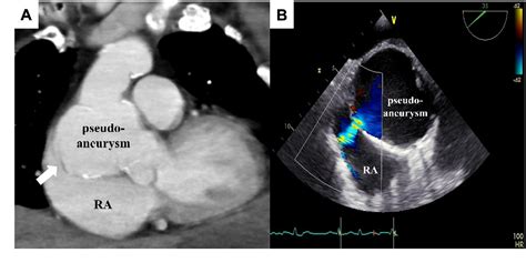 Figure 2 From Acute Heart Failure Due To A Fistula Between The