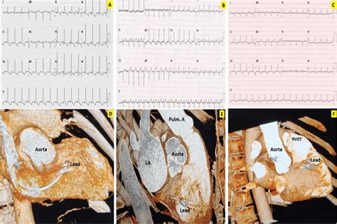 Left Bundle Branch Pacing A Shows Main Left Bundle Capture B Shows Download Scientific