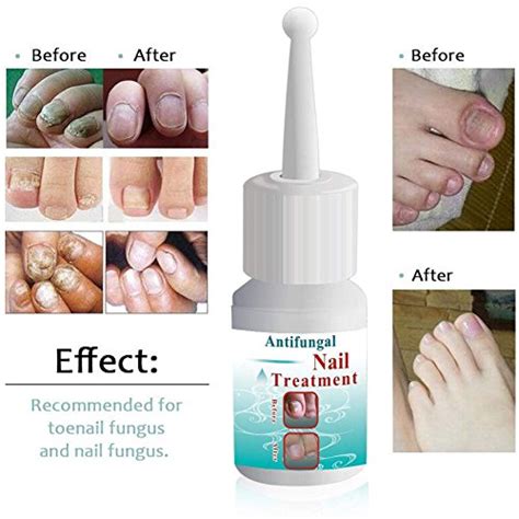 Fungus Stopnail Fungus Treatmentanti Fungal Nail Solutionnail Care