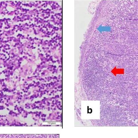 Lymph Node Biopsy A Epithelioid Histiocytes Forming Granuloma