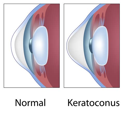 Corneal Crosslinking Treatment For Keratoconus