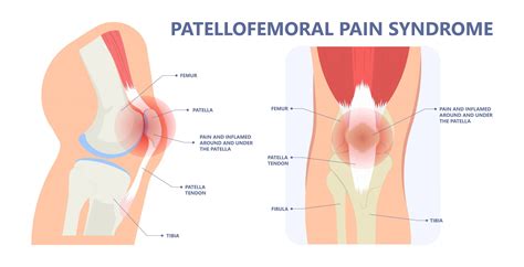 Anterior Knee Pain Surgery Knee Hip And Shoulder